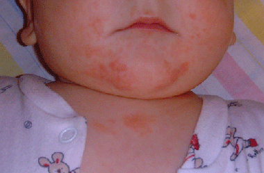 Аллергия у грудничка: как помочь ребенку?
