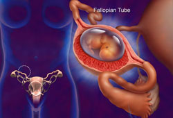 Механизм возникновения внематочной беременности