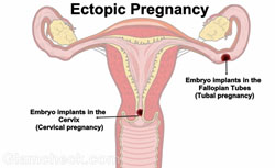 Выявление внематочной беременности. Диагностика