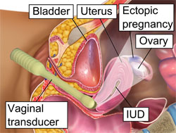 Признаки, последствия и диагностика внематочной беременности