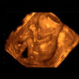 3D узи эмбриона на 19 неделе