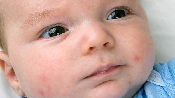 Крапивница у ребенка: фото, симптомы, как быстро вылечить крапивницу у ребенка, препараты и диета