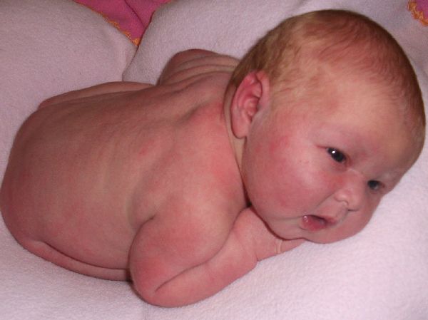 Крапивница у ребенка: фото, симптомы, как быстро вылечить крапивницу у ребенка, препараты и диета