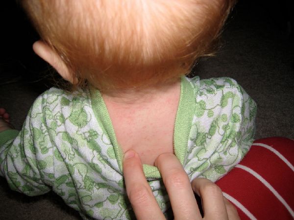 Краснуха у ребенка: признаки и симптомы, профилактика, лечение краснухи у детей
