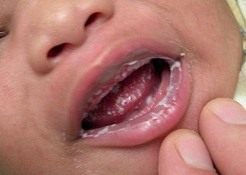 заболевание полости рта